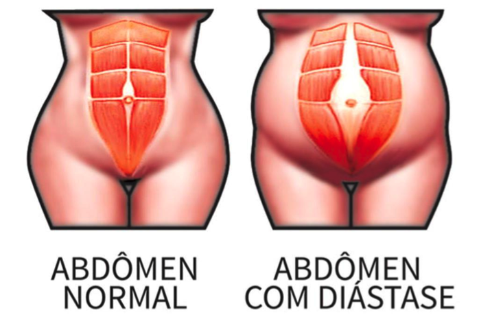 Featured image of post Imagens De Gravidez Abdominal : Os médicos concordam que exercícios durante a gravidez são recomendados, principalmente quando a mulher já praticava antes de engravidar.